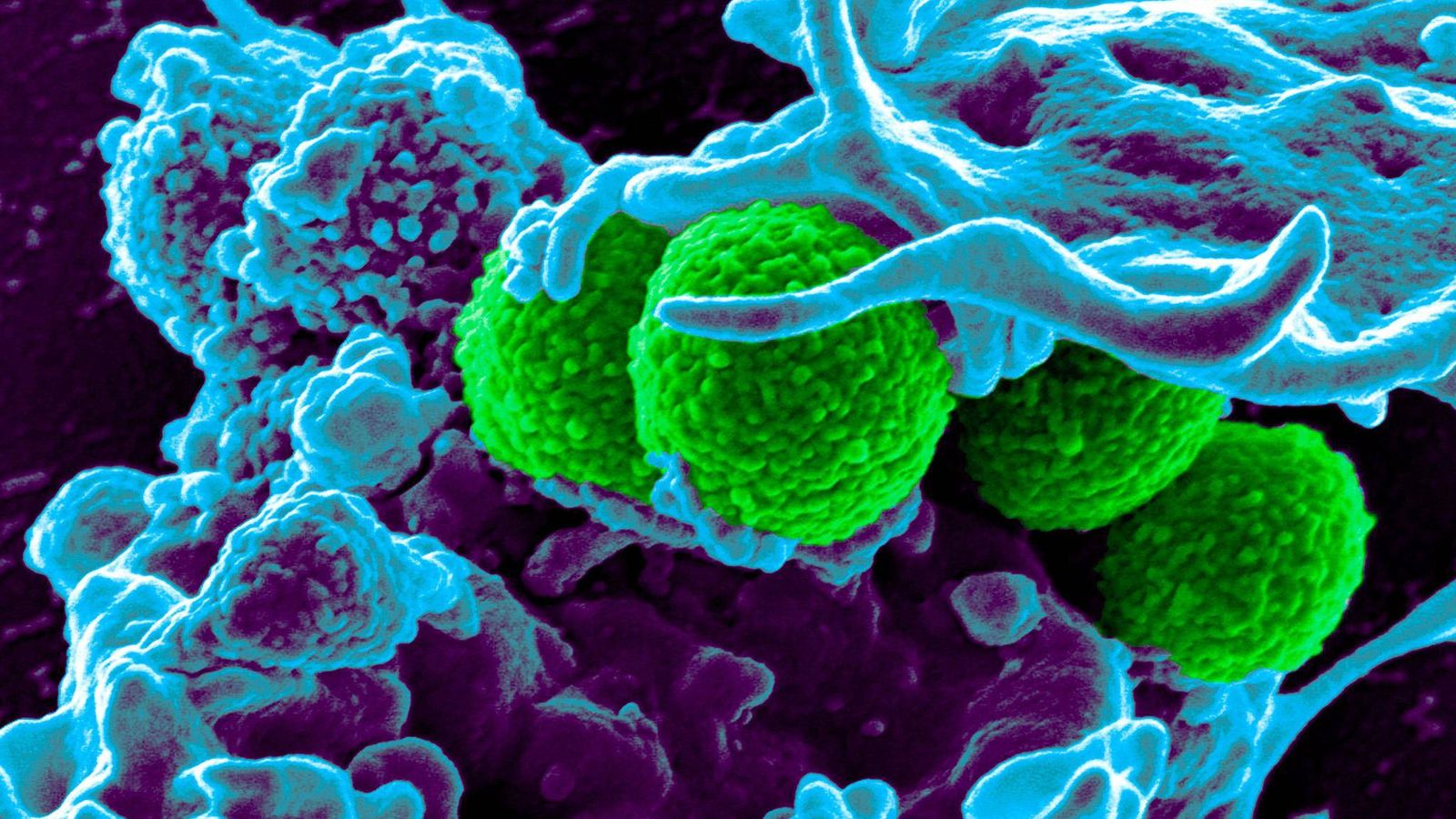Enfermedades infecciosas originadas por bacterias