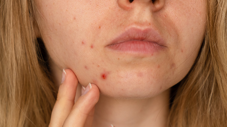 Qué es la hiperpigmentación de la piel y cómo combatirla